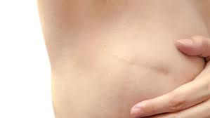 Lipofilling après mastectomie