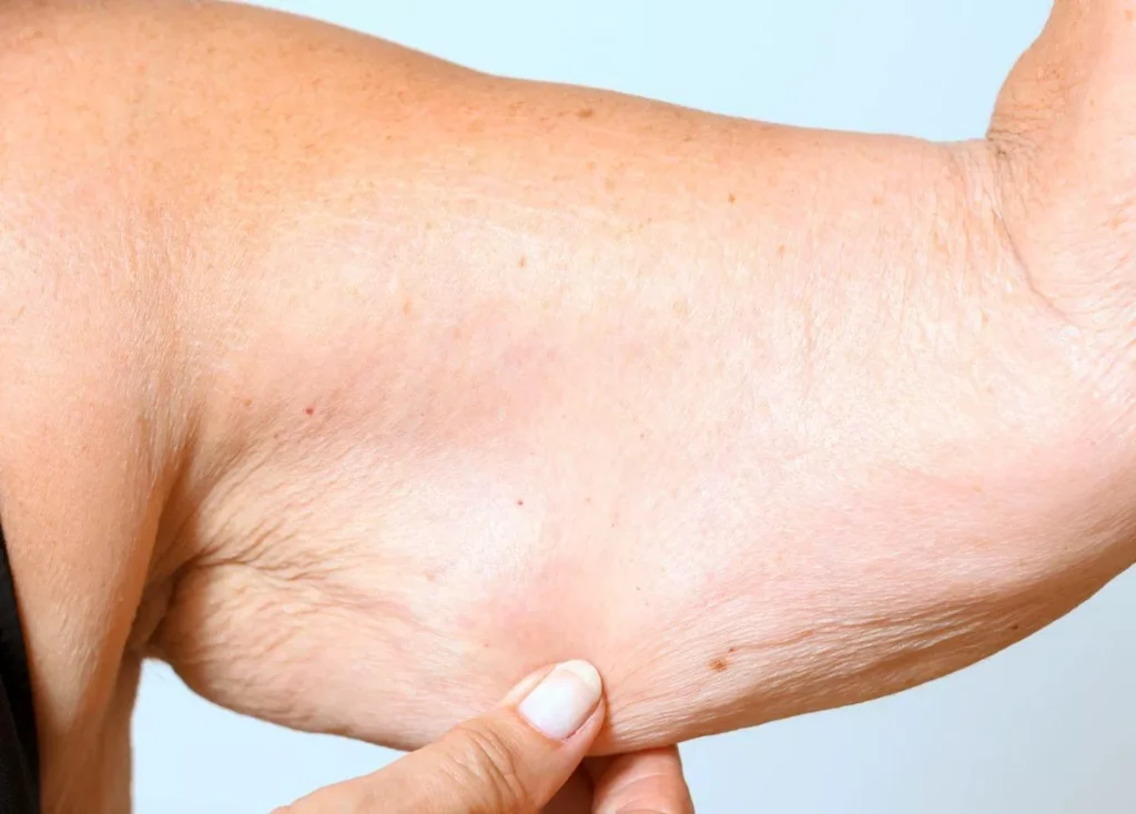 Chirurgie de lifting des bras