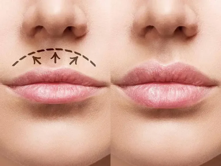 lifting des lèvres / Lip Lift