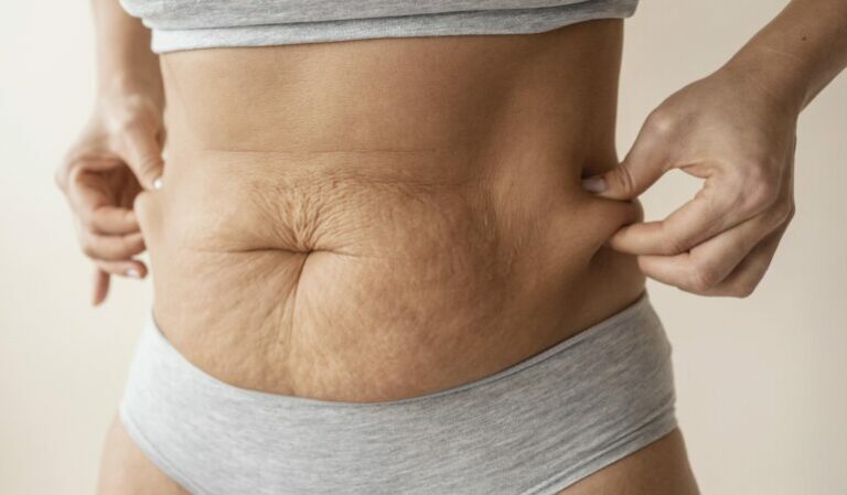 Lipoabdominoplastie