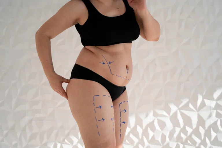 Lipo vaser d'une femme pour obtenir une silhouette sculptée