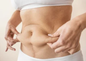 Liposuccion