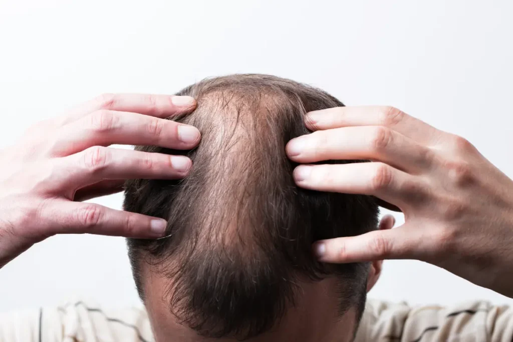 Greffe de Cheveux en Turquie