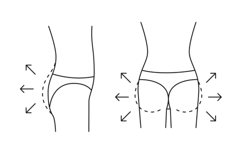 BBL en Turquie - augmentation des fesses