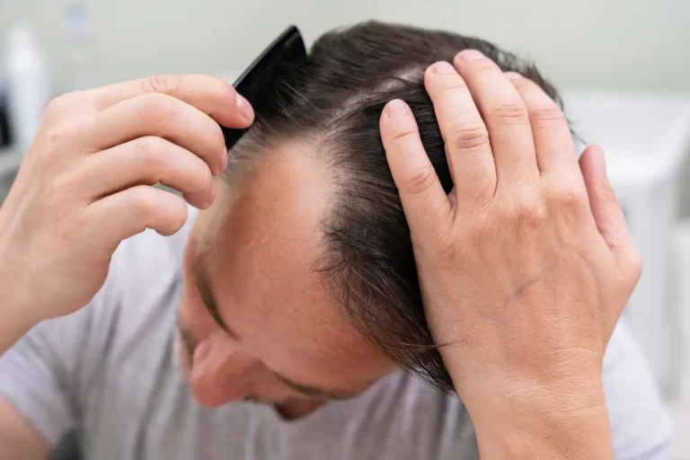 Greffe de Cheveux en Turquie