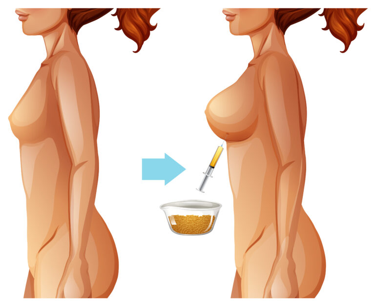 Lipofilling des seins en Turquie