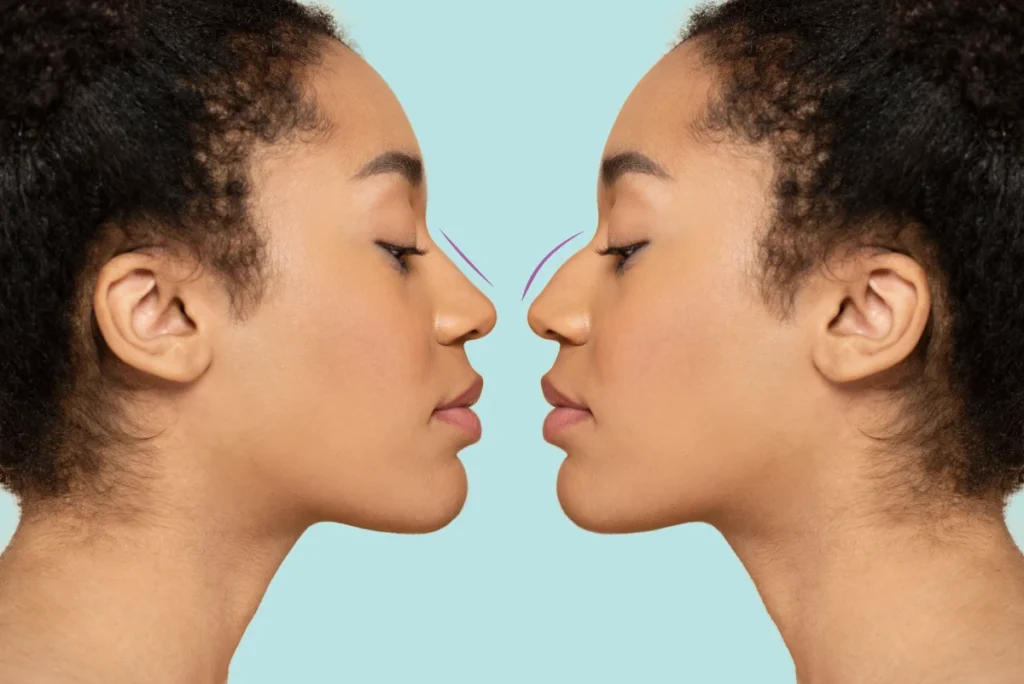 rhinoplastie ethnique