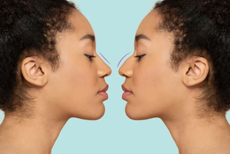rhinoplastie ethnique