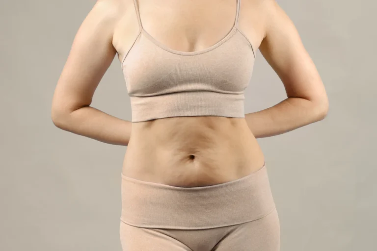 Abdominoplastie secondaire