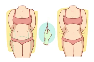 Liposuccion et liposculpture