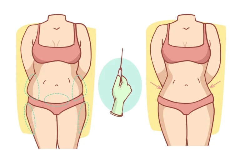Liposuccion et liposculpture
