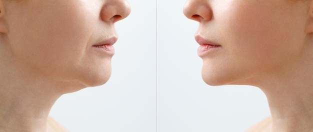 Before and after of non-surgical chin lift with thread lift in a clinic