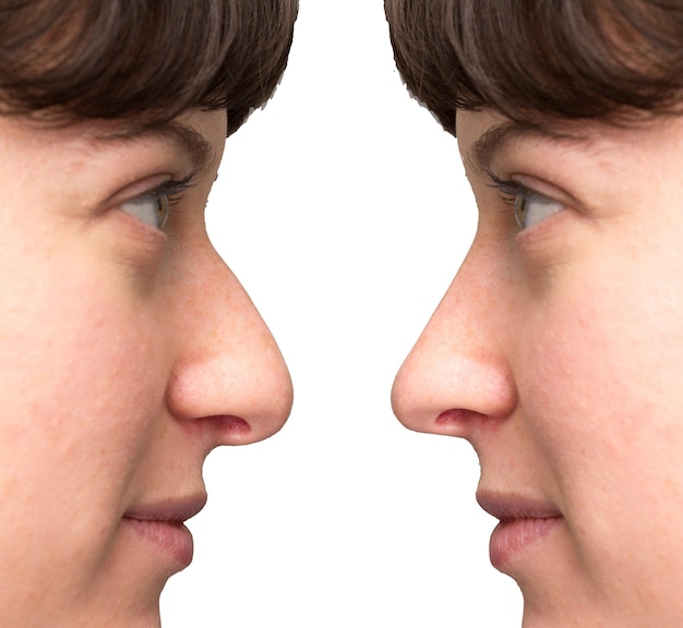 Before and after rhinoplasty for crooked nose correction in a modern clinic