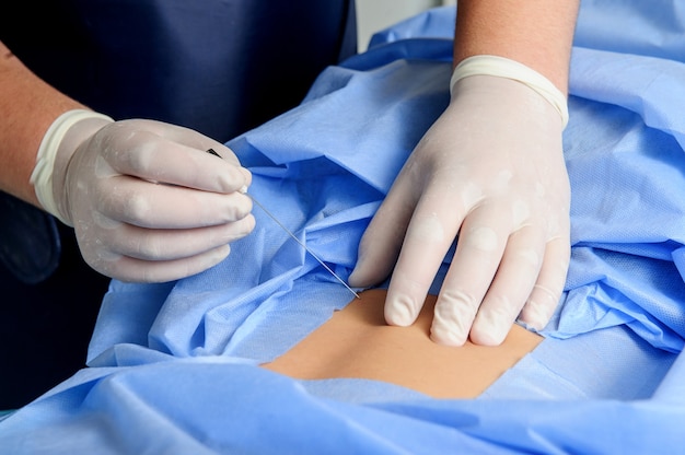 Illustration of a lymphovenous bypass procedure for Alzheimer's treatment showing brain anatomy