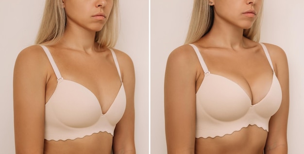Before and after photo of breast augmentation with round implants
