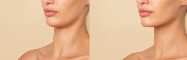 Before and after comparison of non-surgical chin lift with thread lift in a clinic