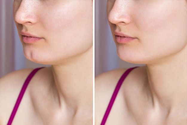 Woman before and after laser chin surgery, showing defined jawline in a clinic in Tunisia