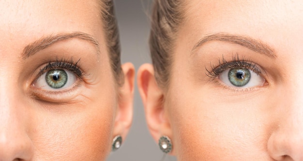 Before and after photo of upper eyelid blepharoplasty surgery showing rejuvenated eye area