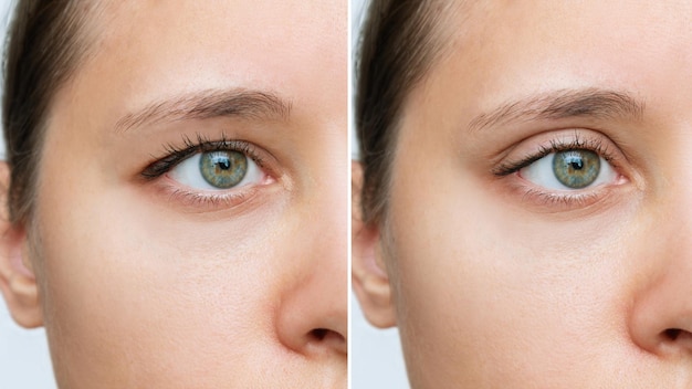 Before and after photo of blepharoplasty on a young patient showing corrected droopy eyelids
