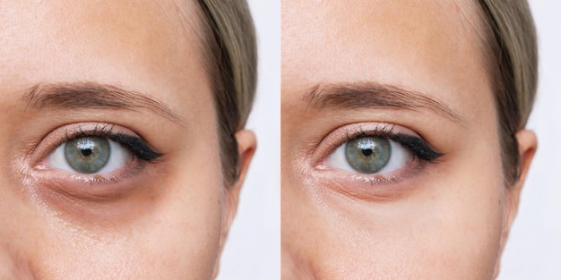 Before and after photo of laser eyelid surgery showing rejuvenated eye area