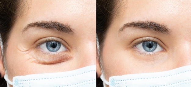 Before and after photo of upper eyelid surgery patient in a clinic