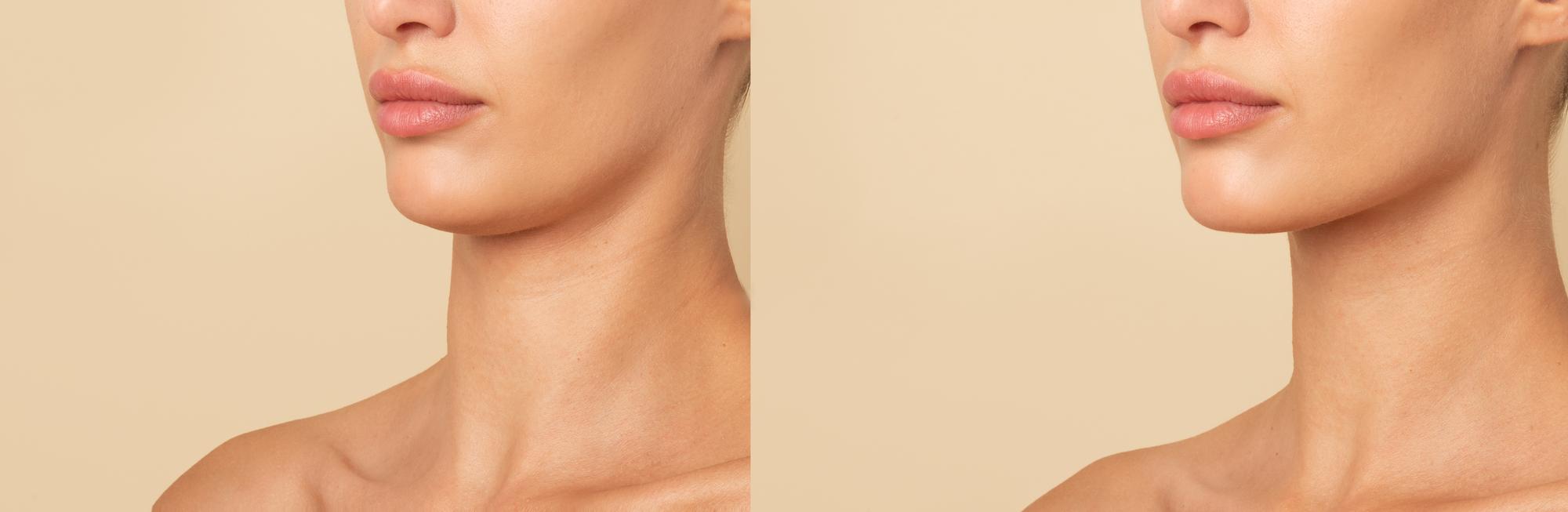 Before and after photo of enzyme therapy for double chin treatment in a clinic