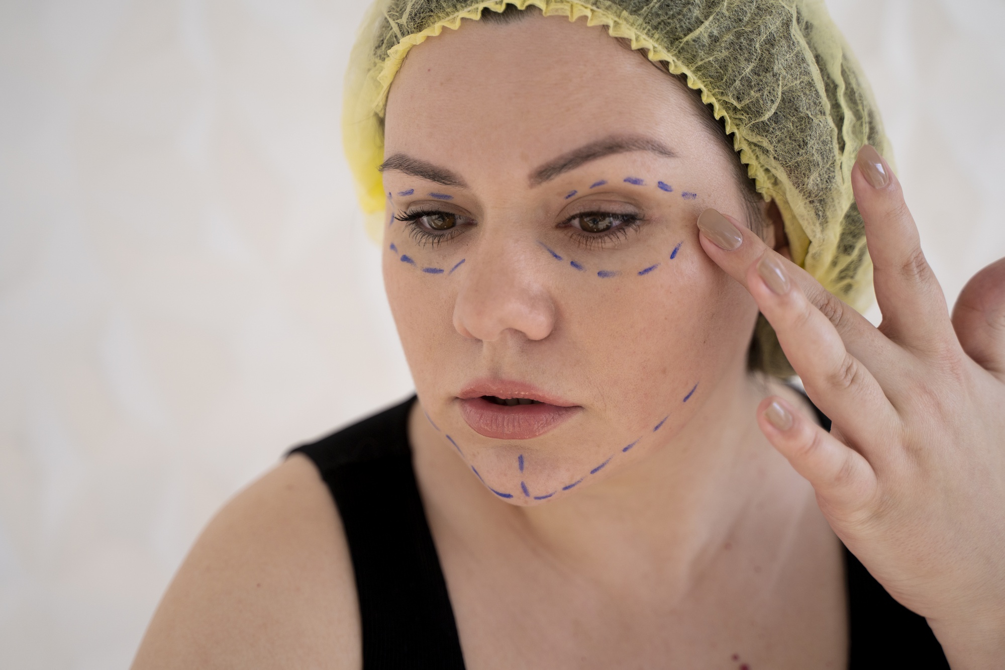 Patient avant et après lifting visage réalisé en Tunisie par un chirurgien esthétique certifié