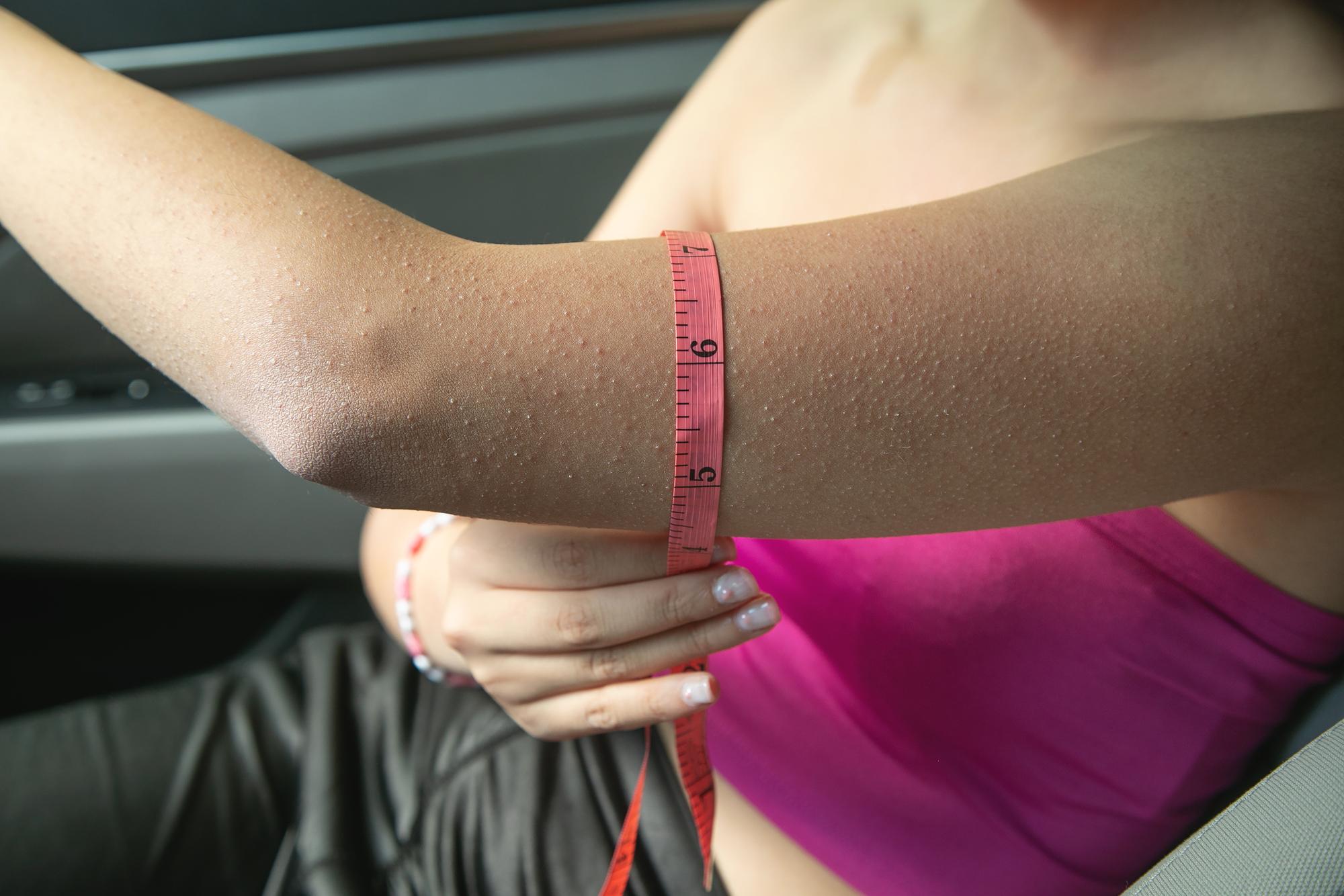 Result of arm liposuction before and after in Tunisia clinic