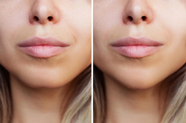 Before and after photo of laser lip reduction surgery showing thinner, more defined lips
