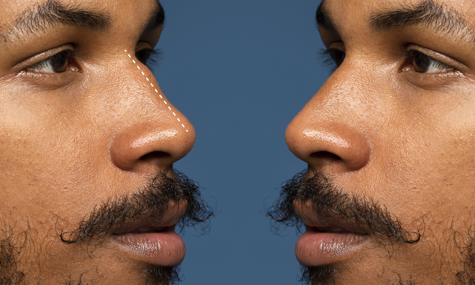 Before and after of ethnic rhinoplasty in Tunisia showing natural results for African nose