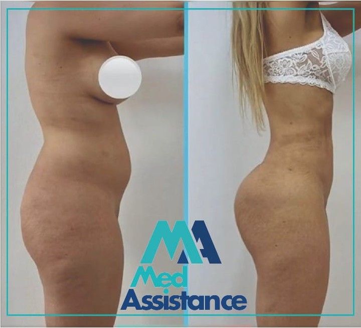 BBL (lipofilling fessier) : photo avant et après publiée par Med Assistance