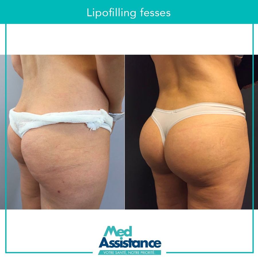 BBL (lipofilling fessier) : photo avant et après publiée par Med Assistance