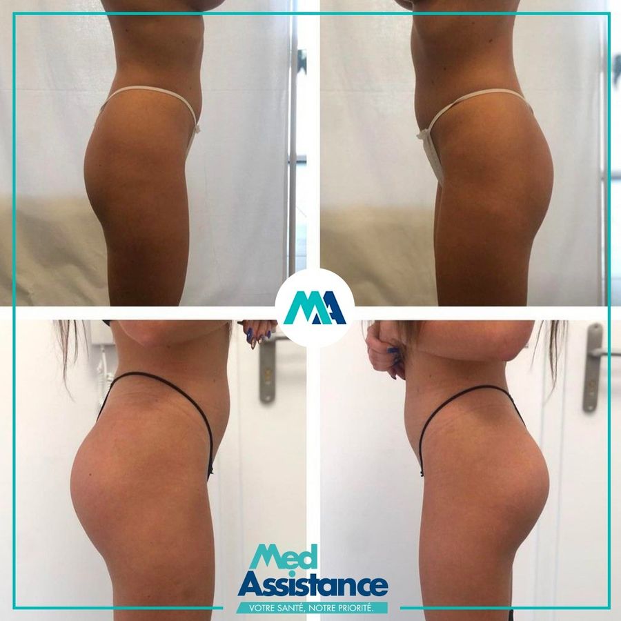 BBL (lipofilling fessier) : photo avant et après publiée par Med Assistance