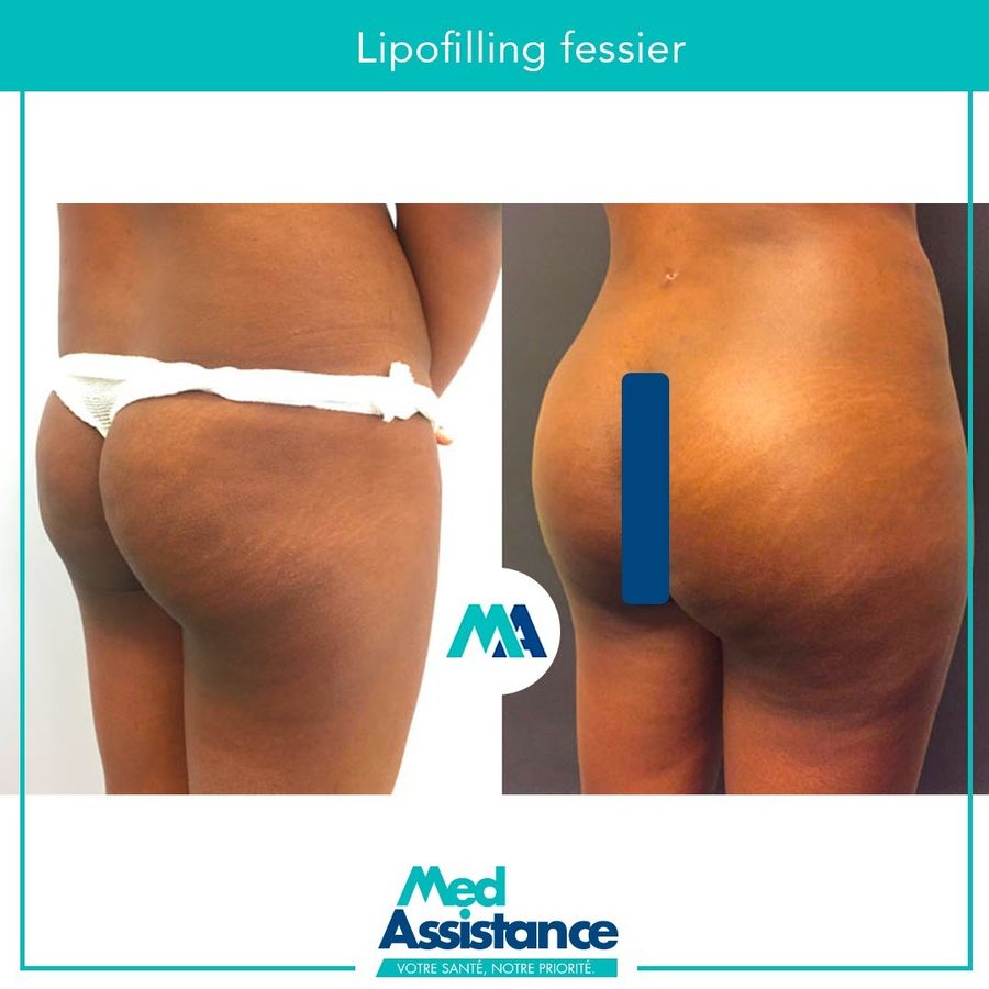 BBL (lipofilling fessier) : photo avant et après publiée par Med Assistance