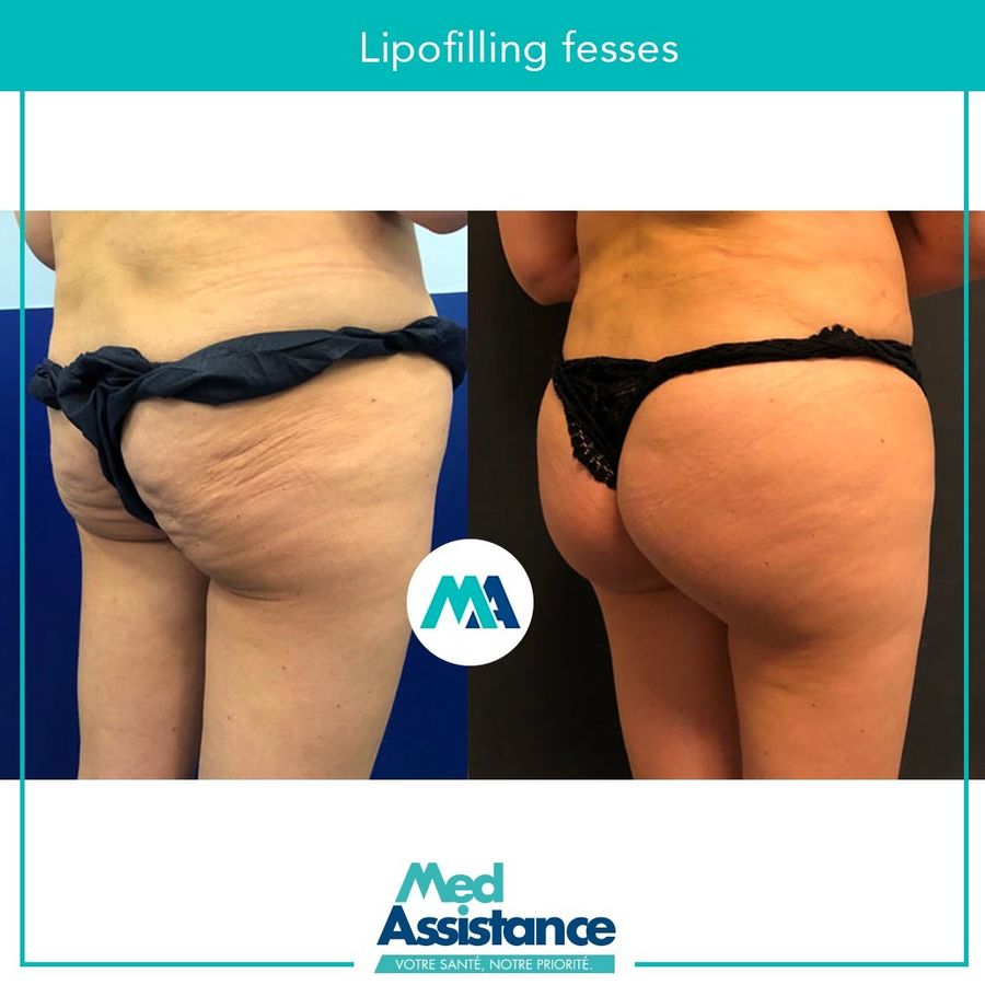 BBL (lipofilling fessier) : photo avant et après publiée par Med Assistance