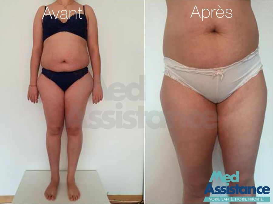 Liposuccion : photo avant et après publiée par Med Assistance