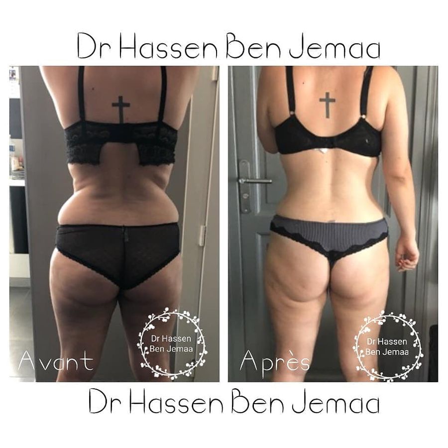 Liposuccion : photo avant et après publiée par Med Assistance