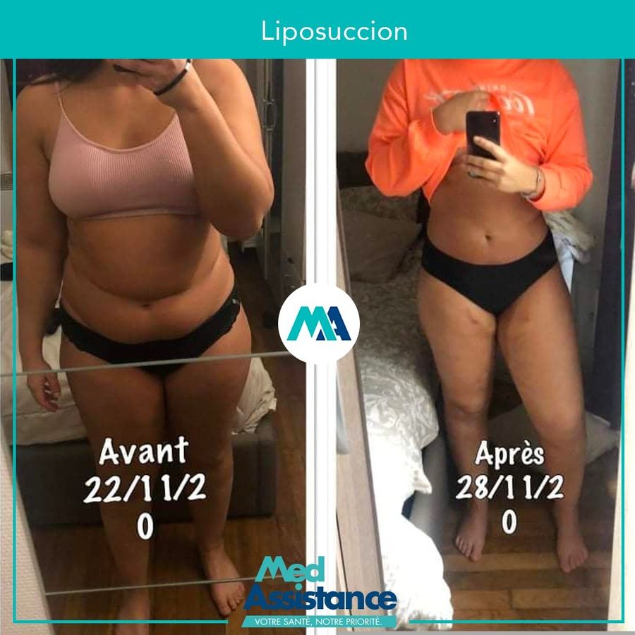 Liposuccion : photo avant et après publiée par Med Assistance