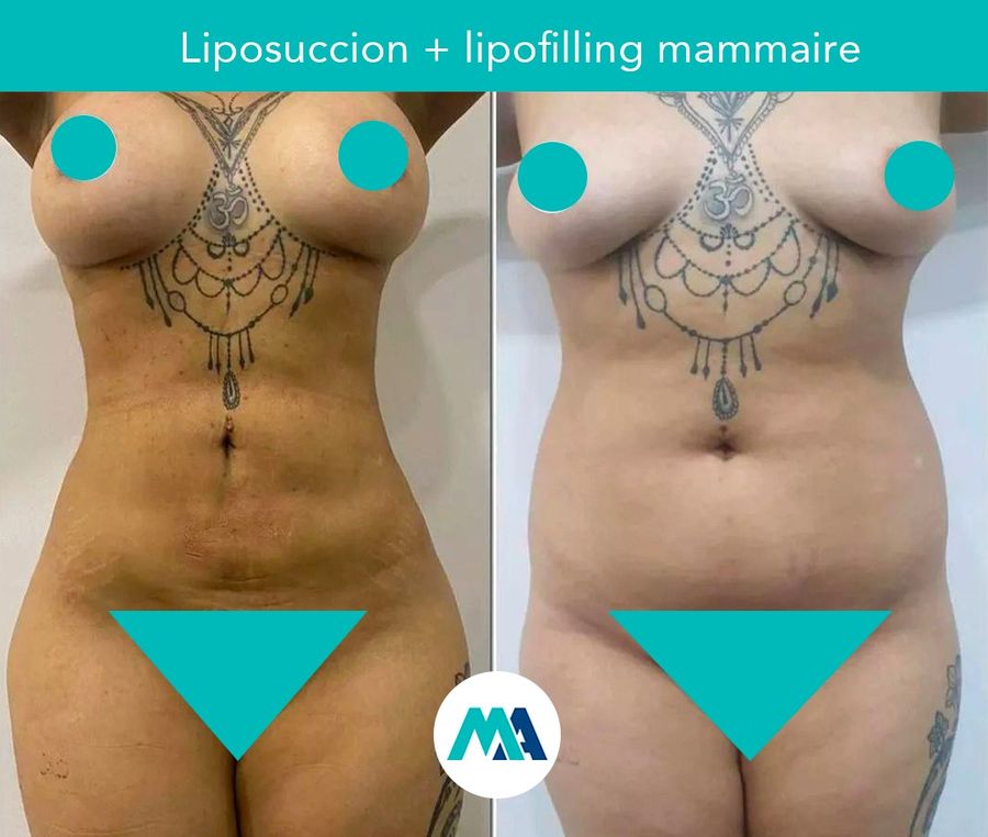 Liposuccion : photo avant et après publiée par Med Assistance