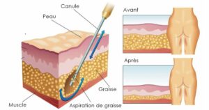 Schéma d’une liposuccion : aspiration de la graisse, avant et après