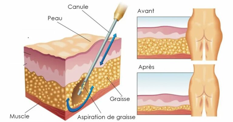 Schéma d’une liposuccion : aspiration de la graisse, avant et après