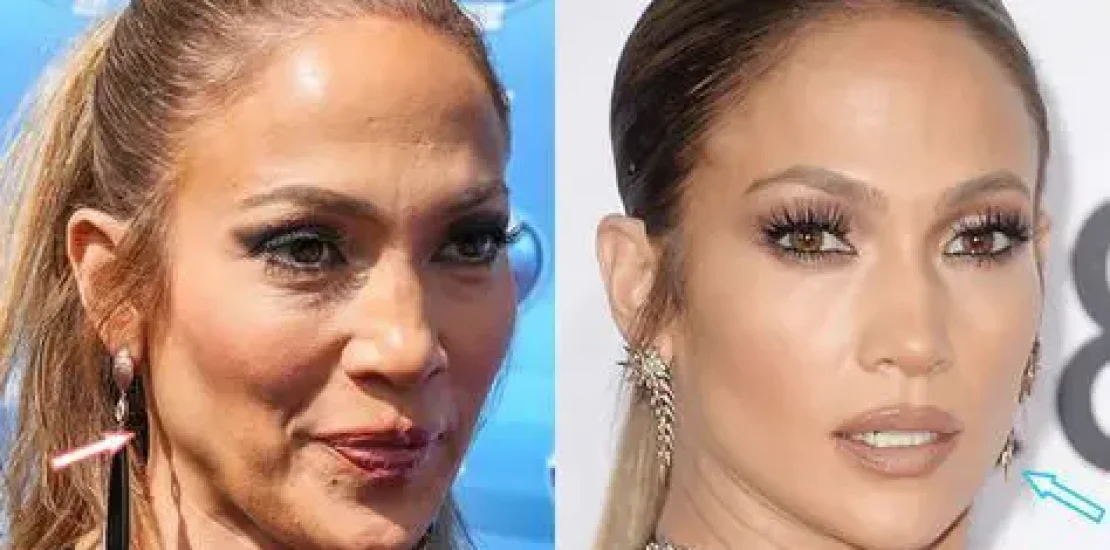 Jennifer Lopez lifting du visage