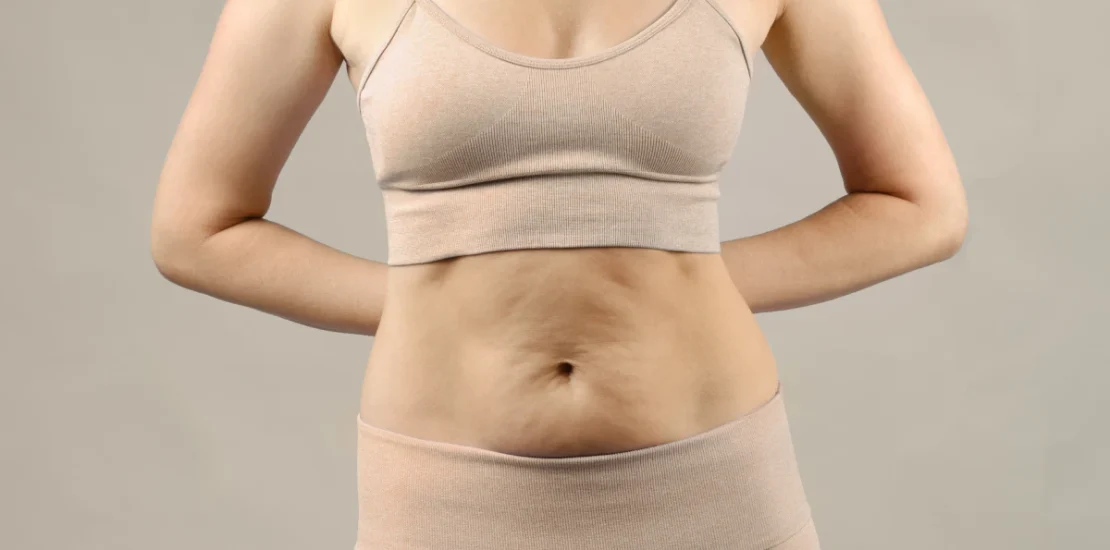Abdominoplastie secondaire