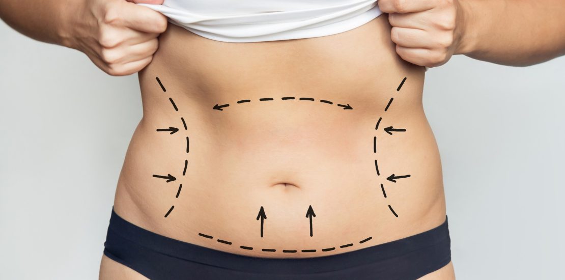 abdominoplastie-tunisie-prix-deroulement-resultats.jpg