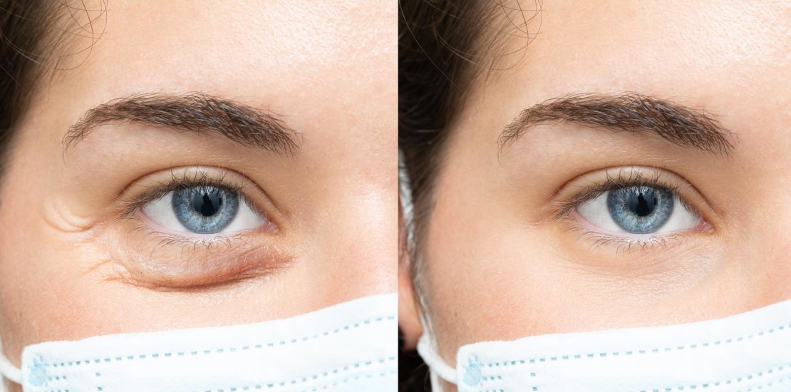 blepharoplastik-tunesien-preise-all-inclusive-2026.jpg