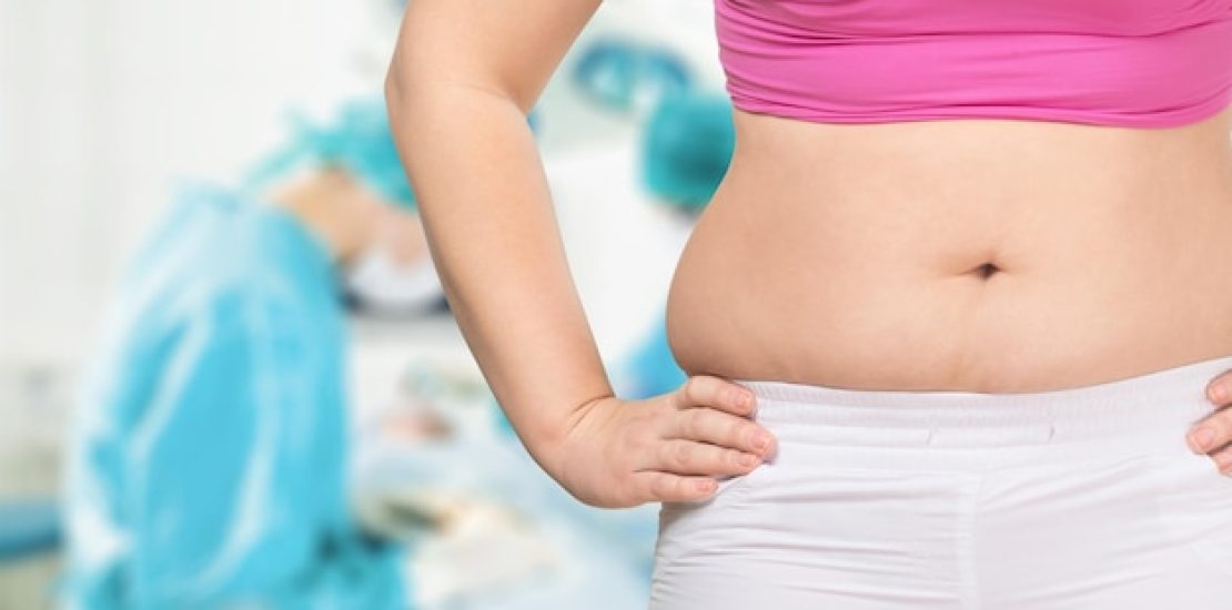 buikwandcorrectie-na-bariatrische-chirurgie.jpg