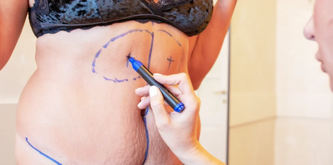 Chirurgie esthétique post-grossesse