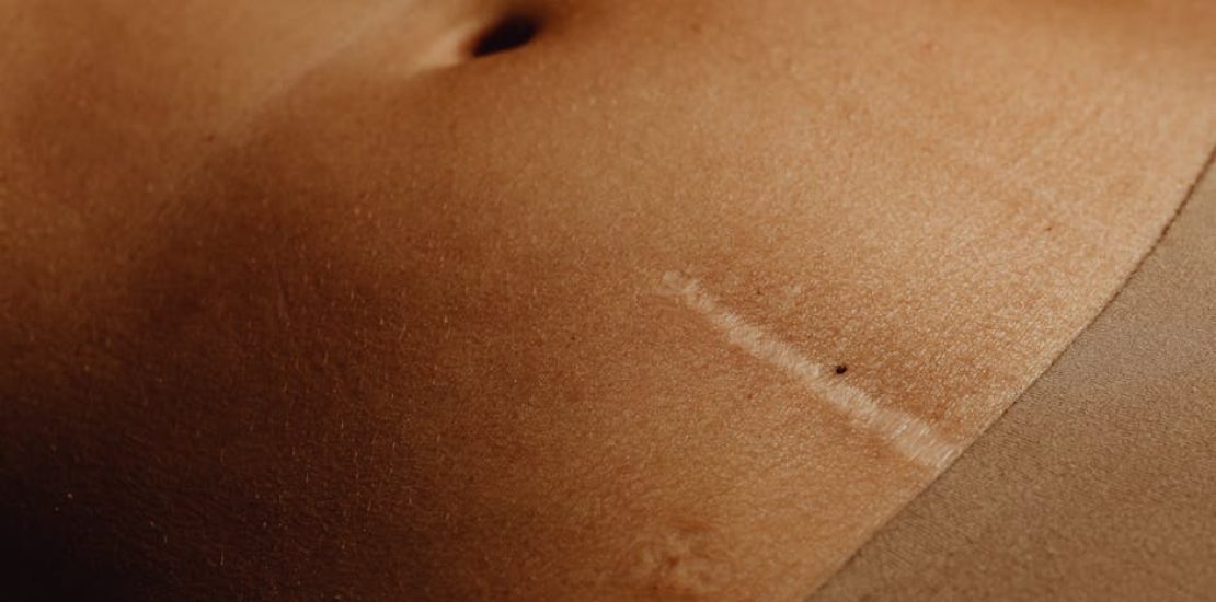 chirurgie-tablier-grossesse-apres-accouchement-prix-tunisie.jpg
