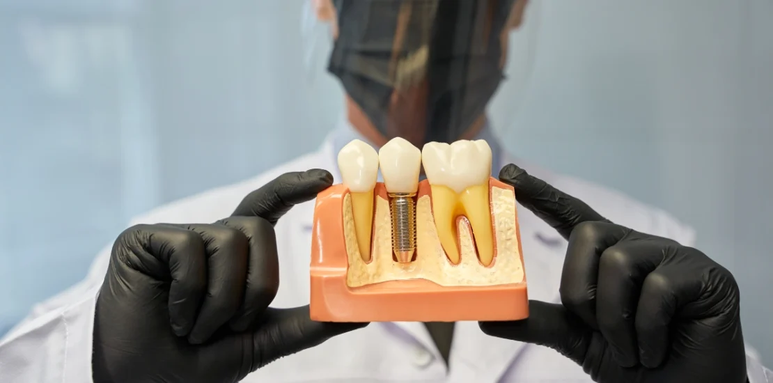 Implants dentaires en Tunisie
