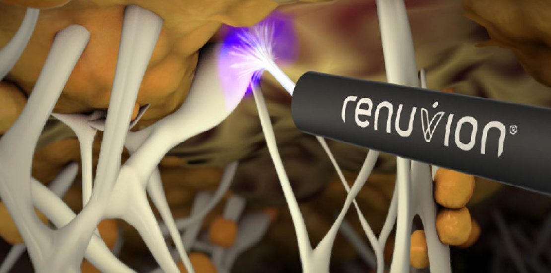 Renuvion J-Plasma